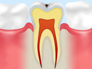 C0 【ごく初期のむし歯】