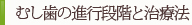 むし歯の進行段階と治療法