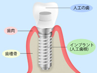 インプラントについて