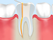 根管内の殺菌